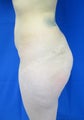 Butt augmentation