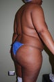 Brazilian Butt Lift