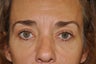 Forehead Lift