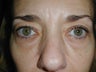 Forehead Lift