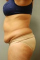 51 Year Old Female Treated for UnWanted Fat With SmartLipo and Vaser Laser