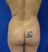 Brazilian Butt Lift