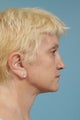 Neck Lift