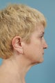 Neck Lift