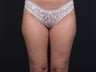 Liposuction Inner & Outer Thighs