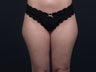 Liposuction Inner & Outer Thighs