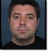 Neck Reduction Using Laser Liposuction