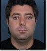 Neck Reduction Using Laser Liposuction