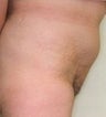 Female patient who underwent surgery for major weight loss 