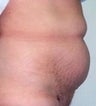 Female patient who underwent surgery for major weight loss 