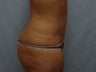 Tummy Tuck