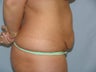 Tummy Tuck