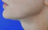 48 Year Old Female- Treated Lower Face
