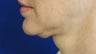 48 Year Old Female- Treated Lower Face