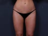 Liposuction