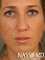 Female Revision Rhinoplasty 