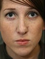 Female Revision Rhinoplasty 