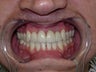 Porcelain Veneers