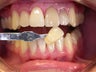 Porcelain Veneers