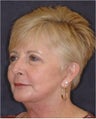 Facelift, chin implant, blepharoplasty, TCA peel