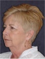 Facelift, chin implant, blepharoplasty, TCA peel
