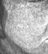 Fraxel re:pair (repair) CO2 laser resurfacing for pigmentation