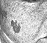Fraxel re:pair (repair) CO2 laser resurfacing for pigmentation