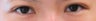 Bilateral Asian Blepharoplasty