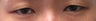 Bilateral Asian Blepharoplasty
