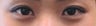 Bilateral Asian Eyelid Surgery