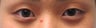 Bilateral Asian Eyelid Surgery