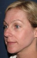 Before & After Botox in San Diego 
