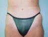 Tummy Tuck