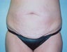 Tummy Tuck