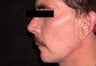 Male Chin Augmentation
