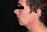 Male Chin Augmentation