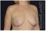 Breast Lift