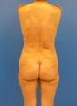 Brazilian Butt Lift 