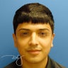 Otoplasty 