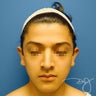 Otoplasty 