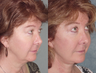 Facelift