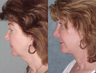 Facelift