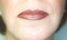Female patient who underwent laser surgery 