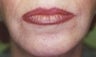 Female patient who underwent laser surgery 
