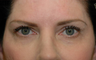 Upper eyelid droop [ptosis] repair with fat grafting to temples