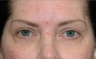 Upper eyelid droop [ptosis] repair with fat grafting to temples