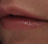 Juvederm