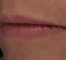Juvederm