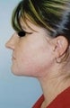 Female patient who received a chin implant 