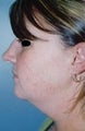 Female patient who received a chin implant 